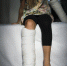 young-caucasian-girl-with-broken-leg-plaster-cast_1.jpg - GorodnaBire.Ru